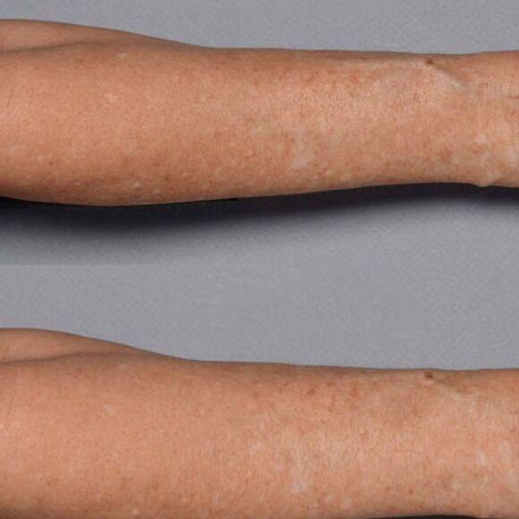 Perricone MD Cold Plasma Plus + Fragile Skin Therapy Body Treatment - Picture 5 of 6